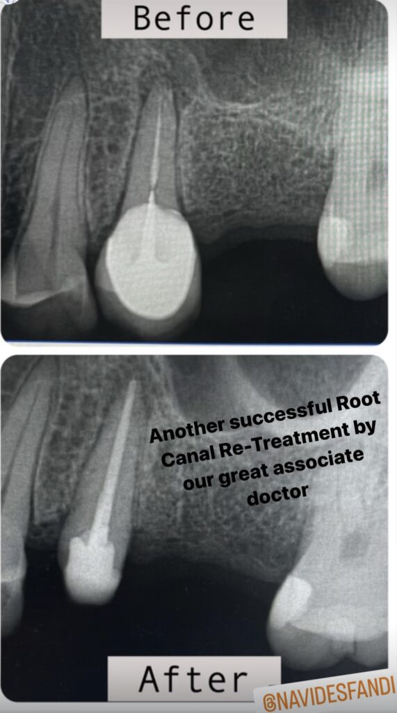Root Canal Therapy in Panorama City