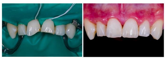 Dental Bonding in Panorama City