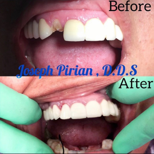 Porcelain Crowns in Panorama City
